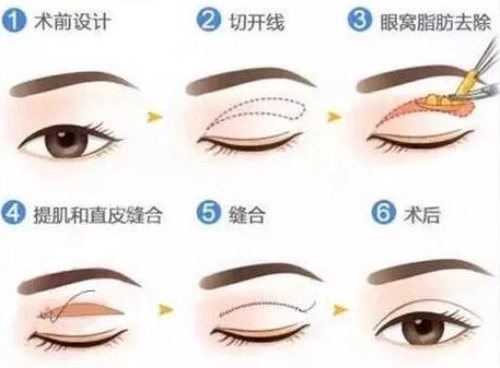 雙眼皮手術示意圖