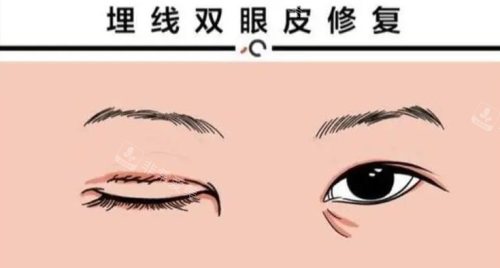 埋線雙眼皮修復圖