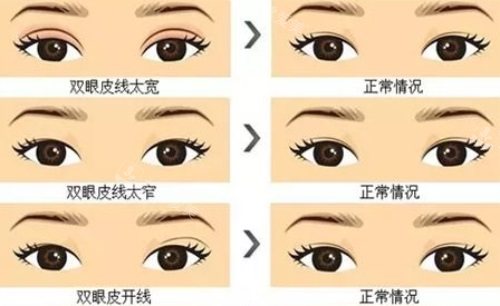 雙眼皮需要修復的情況
