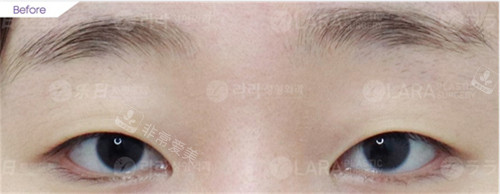 韩国乐日lara整形外科眼部整形术前图