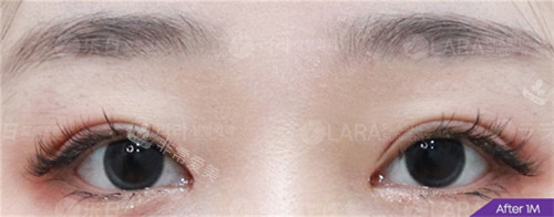 韩国乐日lara整形外科眼部整形术后图