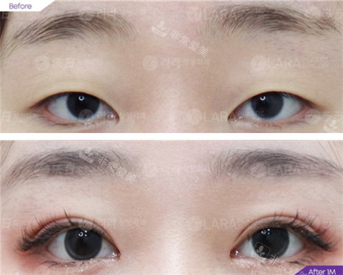韩国乐日lara整形外科眼部整形对比照