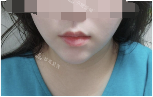 韓國儷伴整形醫(yī)院面部吸脂后示意圖 韓國儷伴整形醫(yī)院面部吸脂后示意圖