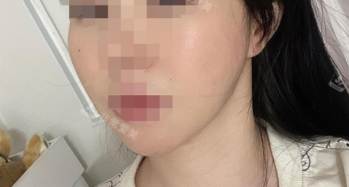 韓國儷伴整形醫(yī)院面部吸脂恢復(fù)好后示意圖 韓國儷伴整形醫(yī)院面部吸脂恢復(fù)好后示意圖