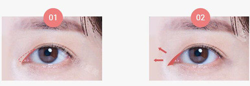 韩国温度整形双眼皮/开眼角手术适合个人眼型/脸型,无疤痕
