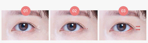 韩国温度整形双眼皮/开眼角手术适合个人眼型/脸型,无疤痕