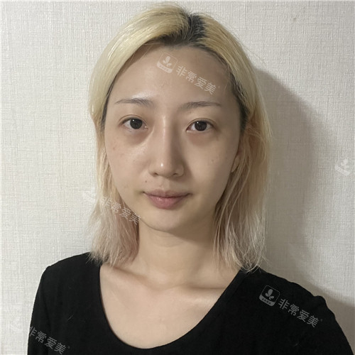 乐日lara整形外科全脸脂肪填充手术和眼底脂肪再配置术前 乐日lara整形外科全脸脂肪填充手术和眼底脂肪再配置术前