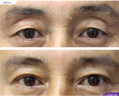 樂日lara整形外科眼部整形對比 樂日lara整形外科眼部整形對比