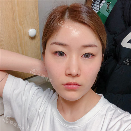 韓國TS整形醫(yī)院輪廓整形術前照片