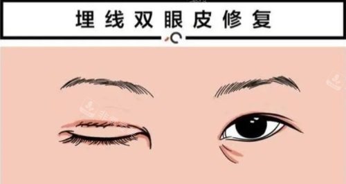 埋線雙眼皮修復(fù)示意圖 埋線雙眼皮修復(fù)示意圖