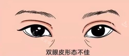 雙眼皮形態(tài)問(wèn)題 雙眼皮形態(tài)問(wèn)題