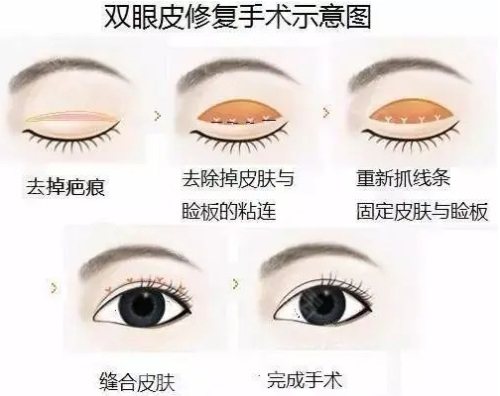 雙眼皮手術(shù)示意圖 雙眼皮手術(shù)示意圖
