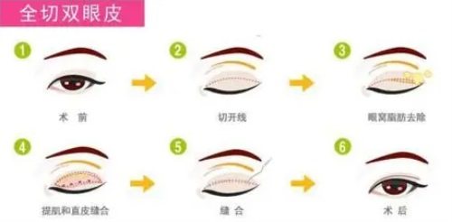 雙眼皮示意圖 雙眼皮示意圖