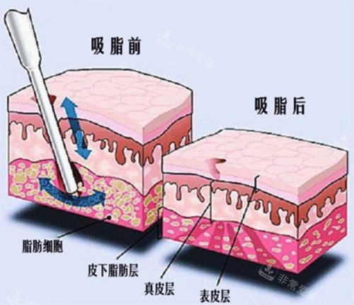 吸脂前后对比图