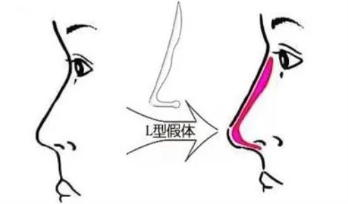 隆鼻示意圖 隆鼻示意圖