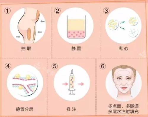 脂肪填充示意圖 脂肪填充示意圖