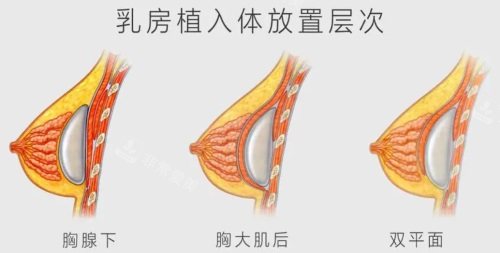 假体隆胸示意图