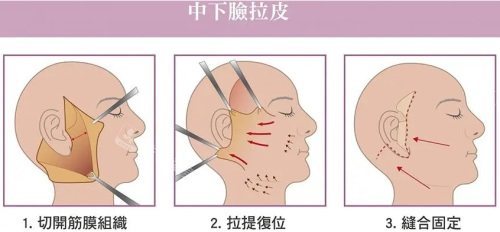拉皮示意圖 拉皮示意圖