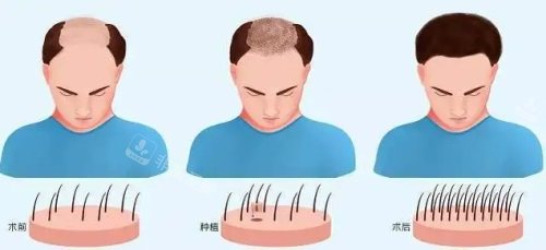 植發(fā)前后對(duì)比圖 植發(fā)前后對(duì)比圖