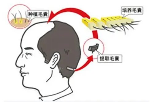種植毛囊示意圖 種植毛囊示意圖