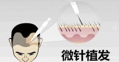 微針植發(fā)示意圖 微針植發(fā)示意圖