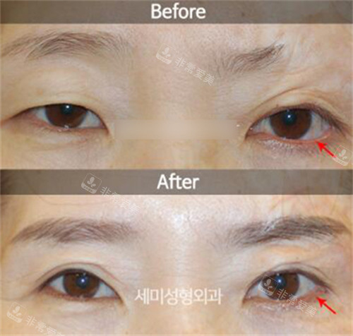 韩国世美整形外科医院眼部修复手术对比