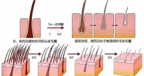 植發(fā)過(guò)程示意圖