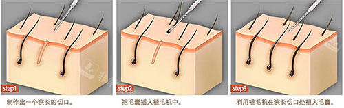 手術(shù)毛發(fā)移植過(guò)程示意圖