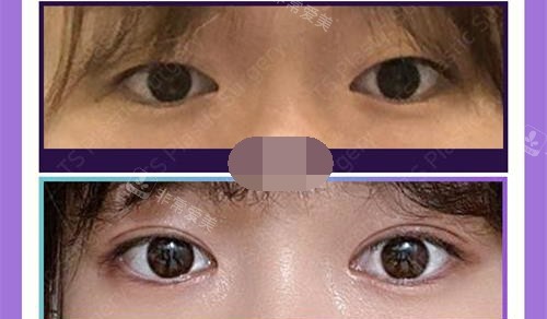 韩国TS整形医院双眼皮修复