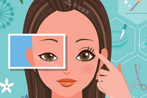双眼皮手术卡通图 双眼皮手术卡通图