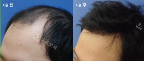 新分享韩国布莱克示例图！植发技术怎么样一目了然！