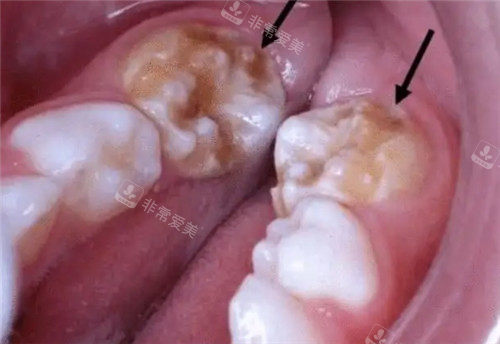牙齒齲壞照片 牙齒齲壞照片
