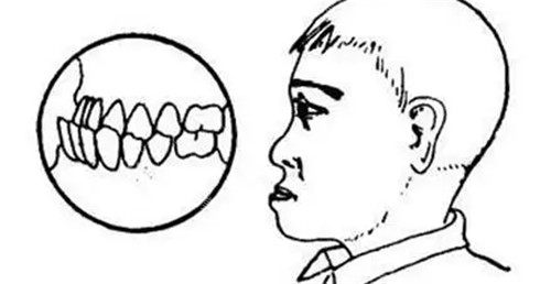 地包天牙齒表現(xiàn)圖