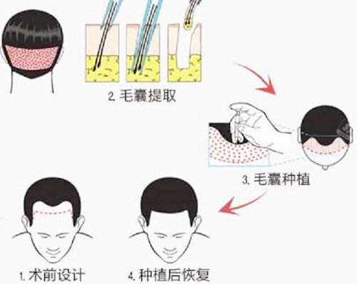 植發(fā)毛囊提取卡通圖 植發(fā)毛囊提取卡通圖