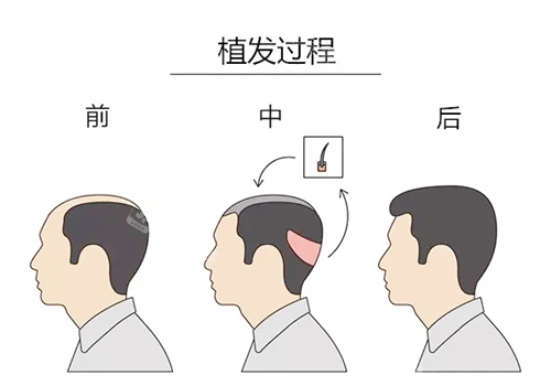植發(fā)過程卡通圖 植發(fā)過程卡通圖