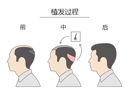 植發(fā)過程卡通圖