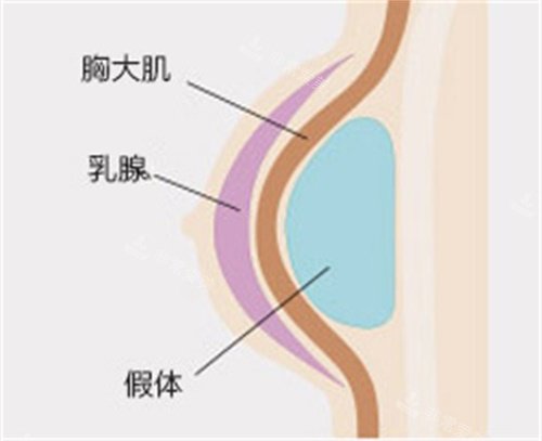 假體位置示意圖