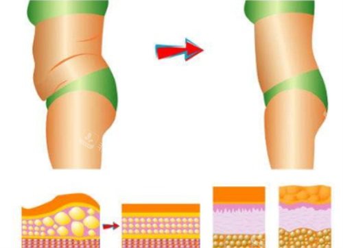 腰腹吸脂示意图