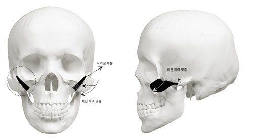 韩国伊美芝整形外科轮廓方法图