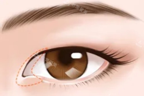 眼角手术展示图