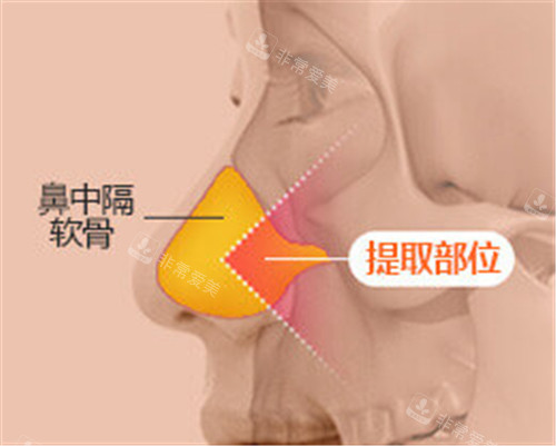 韩国无假体隆鼻手术好的医院推荐GNG整形,无假体隆鼻技术好!