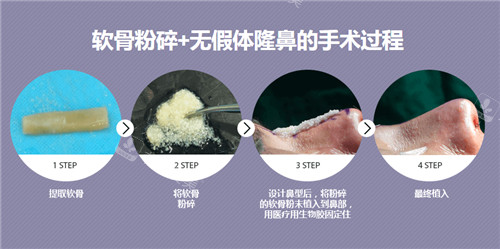 GNG整形医院软骨粉碎隆鼻过程展示