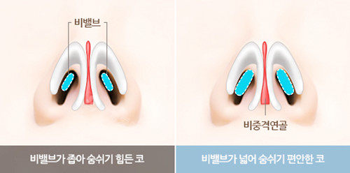 韩国温度整形隆鼻失败修复手术好吗?鼻修复真实病例分享