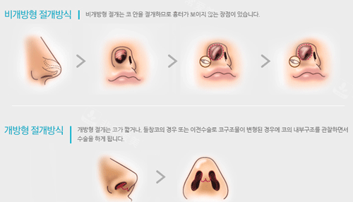 韩国碧夏整形鼻子手术动画示意图
