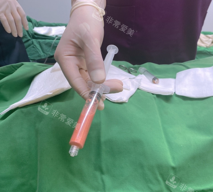 抽吸出來的脂肪照片