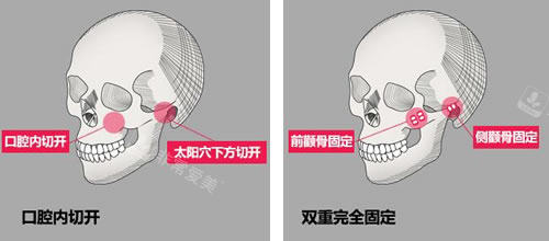 韩国NJH卢钟勋整形颧骨手术流程展示