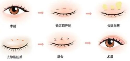 雙眼皮手術(shù)示意圖 雙眼皮手術(shù)示意圖