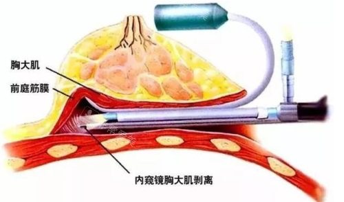 內(nèi)窺鏡隆胸示意圖