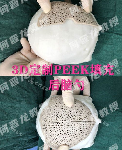 PEEK材料填充后腦勺示意圖 PEEK材料填充后腦勺示意圖