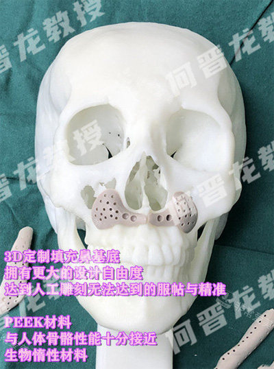 PEEK墊鼻基底展示圖 PEEK墊鼻基底展示圖